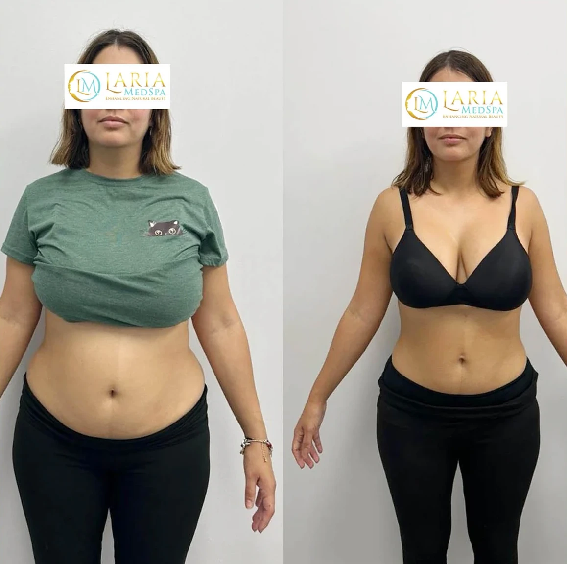 LARIA MedSpa body contouring before and after